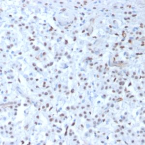IHC of human mesothelioma stained with WT1 Mouse Monoclonal Antibody AE00126