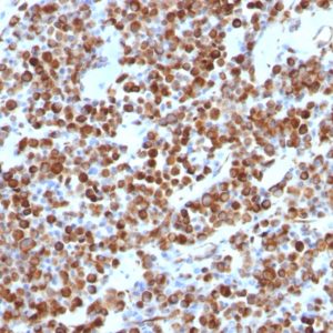 IHC of human melanoma stained with Vimentin Mouse Monoclonal Antibody AE00155