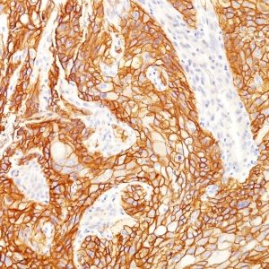 IHC of human squamous cell lung cancer stained with EGFR Mouse Monoclonal Antibody AE00166