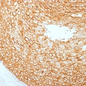 IHC of human breast carcinoma stained with HER2 Mouse Monoclonal Antibody AE00171