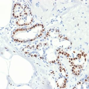 IHC of human breast carcinoma stained with ESR1 Mouse Recombinant Monoclonal Antibody AE00172