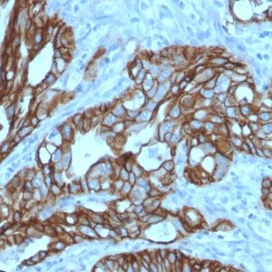 IHC of human colon carcinoma stained with TROP2 Mouse Monoclonal Antibody AE00187