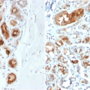 IHC of human breast carcinoma stained with Mammaglobin-A Mouse Monoclonal Antibody AE00189