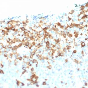 IHC of human malanoma stained with NGFR Mouse Monoclonal Antibody AE00195