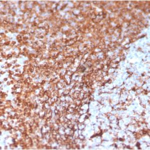 IHC of human prostate carcinoma stained with Vimentin Mouse Monoclonal Antibody AE00237