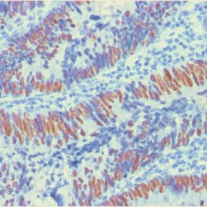 IHC of human colon carcinoma stained with CDX2 Mouse Monoclonal Antibody AE00163