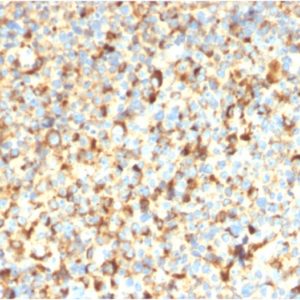 IHC of human melanoma stained with CD36 Mouse Recombinant Monoclonal Antibody AE00244