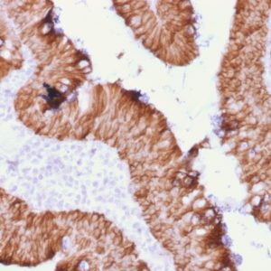 IHC of human colon mass stained with EpCAM Mouse Recombinant Monoclonal Antibody AE00254