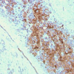 IHC of human melanoma stained with CD63 Mouse Monoclonal Antibody AE00262