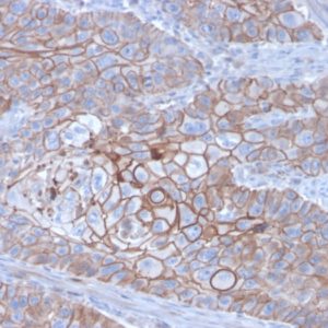 IHC of human breast carcinoma stained with CDH1 Mouse Monoclonal Antibody AE00264
