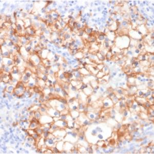 IHC of human renal carcinoma stained with CDH16 Mouse Monoclonal Antibody AE00265