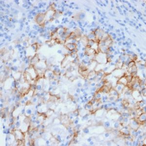 IHC of human renal carcinoma stained with CDH16 Mouse Monoclonal Antibody AE00266