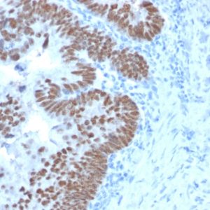 IHC of human colon carcinoma stained with CDX2 Mouse Monoclonal Antibody AE00268