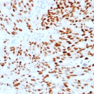 IHC of human endometrial carcinoma stained with ESR1 Mouse Monoclonal Antibody AE00272