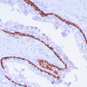 IHC of human prostate carcinoma stained with KRT15 Mouse Monoclonal Antibody AE00282