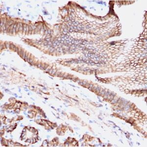 IHC of human prostate carcinoma stained with TROP2 Mouse Monoclonal Antibody AE00284