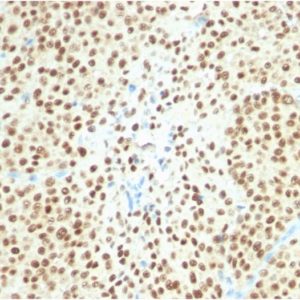 IHC of human melanoma stained with SOX10 Rabbit Recombinant Monoclonal Antibody AE00288