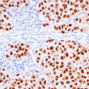 IHC of human melanoma stained with SOX10 Mouse Recombinant Monoclonal Antibody AE00289