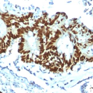 IHC of human colon carcinoma stained with TP53 Rabbit Recombinant Monoclonal Antibody AE00291