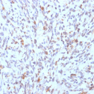 IHC of human rhabdomyosarcoma stained with MyoD1 Mouse Recombinant Antibody AE00118