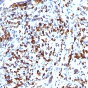 IHC of human rhabdomyosarcoma stained with MyoD1 Rabbit Recombinant Monoclonal Antibody AE00119