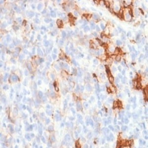 IHC of human melanoma stained with NGFR Rabbit Recombinant Monoclonal Antibody AE00121