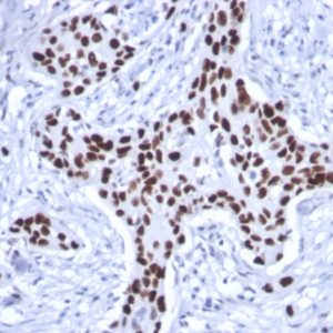IHC of human breast carcinoma stained with TP53 Mouse Recombinant Monoclonal Antibody AE00123