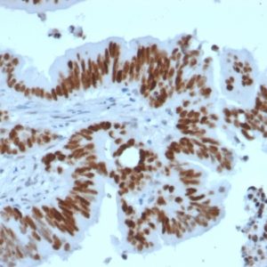 IHC of human colon carcinoma stained with TP53 Rabbit Recombinant Monoclonal Antibody AE00124