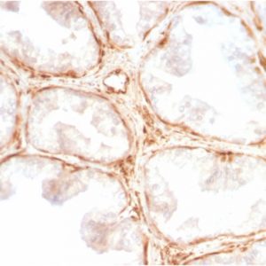 IHC of human prostate carcinoma stained with Galectin-1 Rabbit Recombinant Monoclonal Antibody AE00147