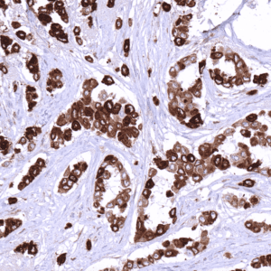 IHC of human invasive lobular carcinoma stained with Mammaglobin-A Rabbit Recombinant Antibody AE00372