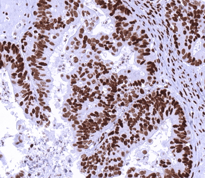 IHC of human ovarian endometrioid carcinoma stained with MSH6 Rabbit Recombinant Antibody AE00380