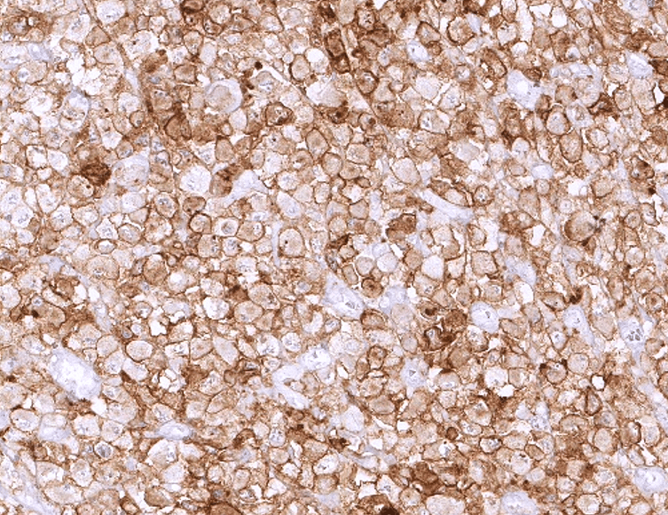 IHC of human large cell lymphoma stained with PD-L1 Rabbit Recombinant Antibody AE00385